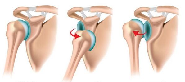 الخلع الأمامي والخلفي لمفصل الكتف، مما يؤدي إلى تطور التهاب المفاصل