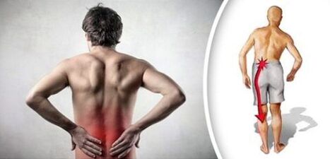 متلازمة الألم مع نضحات العظم القطني على الساقين