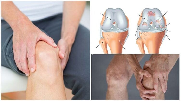 أعراض آلام الركبة لالتهاب المفاصل في الركبة